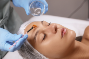 Chemical Peel for face